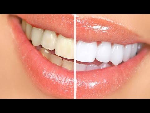 بالفيديو  تعرف على أسهل طريقة لتبيض الأسنان